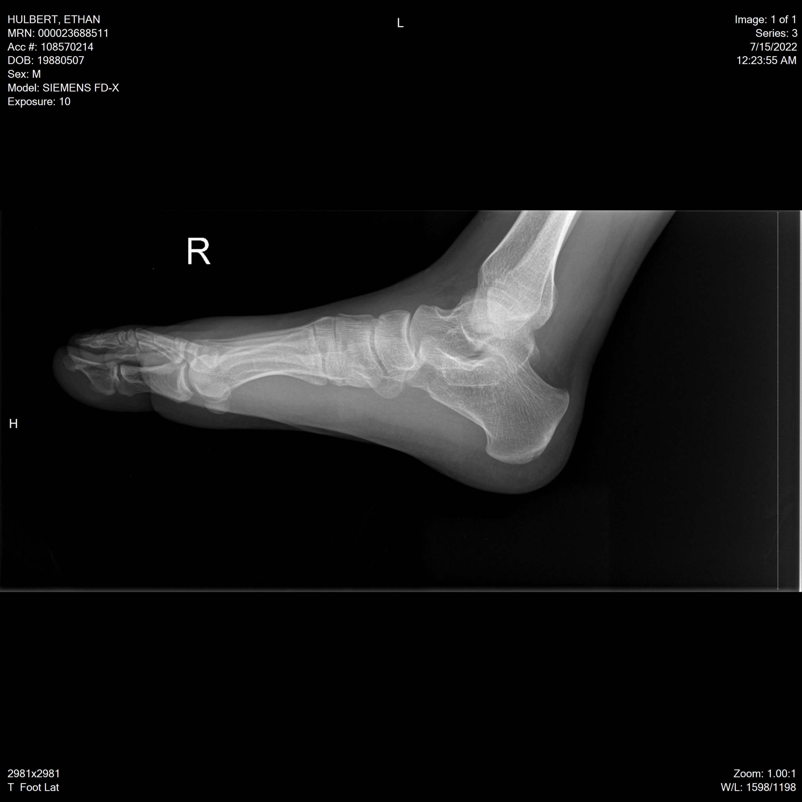 Xray Image Of Broken Calcaneus Lateral And Axial View. Stock Photo, Picture  and Royalty Free Image. Image 39886937.